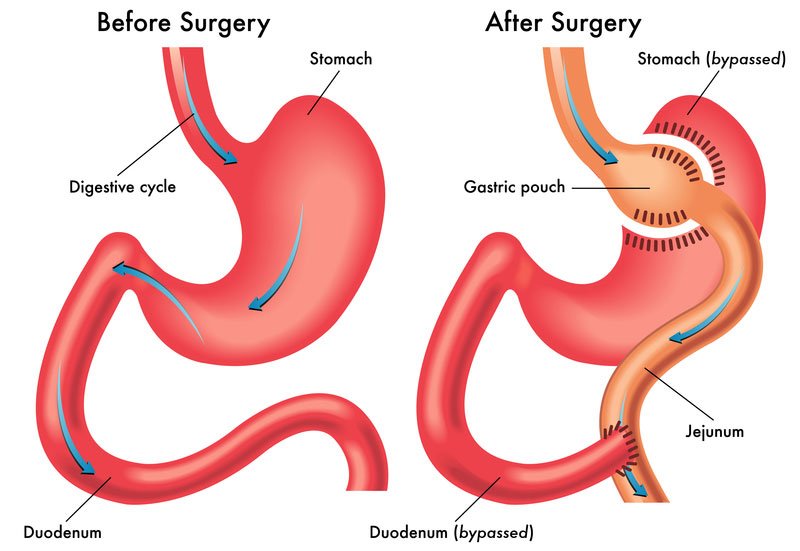 Gastric Bypass: What it is?