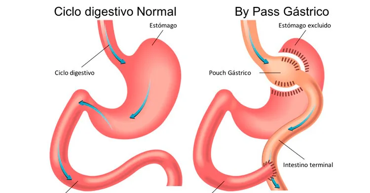 Bypass Gástrico: Qué es